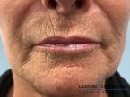 TotalFX: Patient 2 - Before 