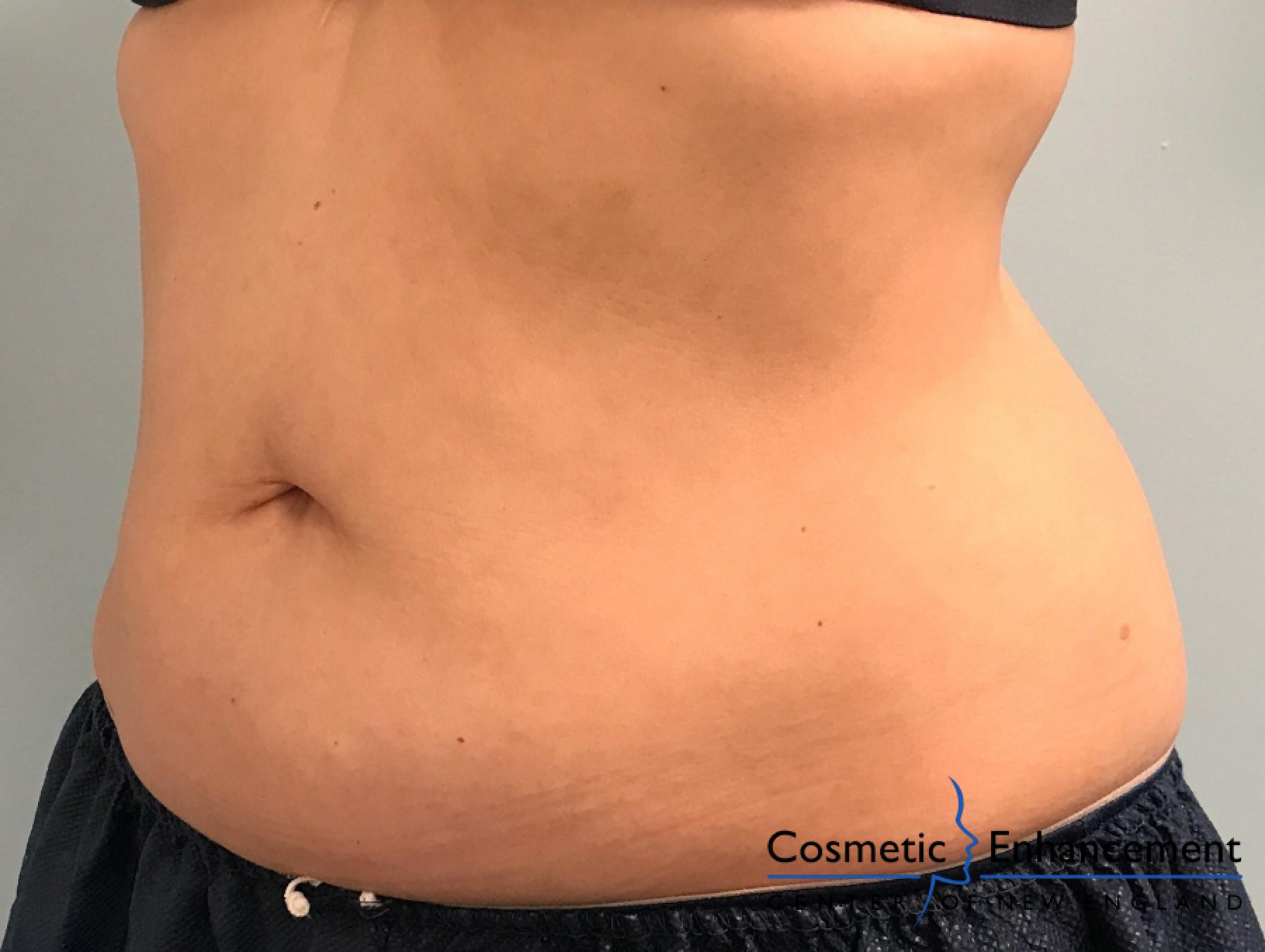 CoolSculpting®: Patient 5 - After  