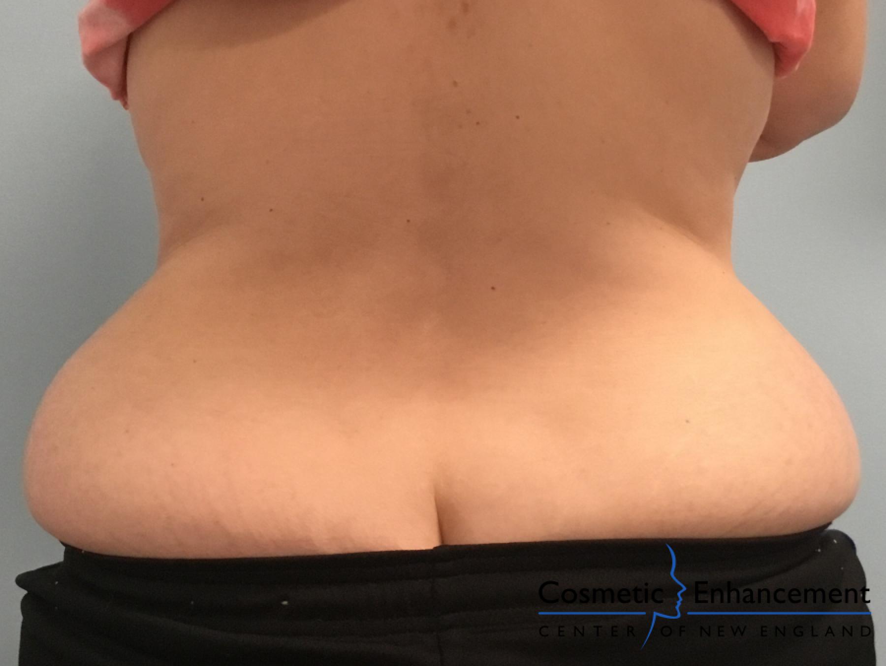 CoolSculpting®: Patient 15 - Before and After 3