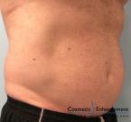 CoolSculpting®: Patient 17 - Before 