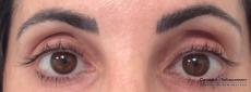 Lash Lift And Tint: Patient 1 - Before Image 