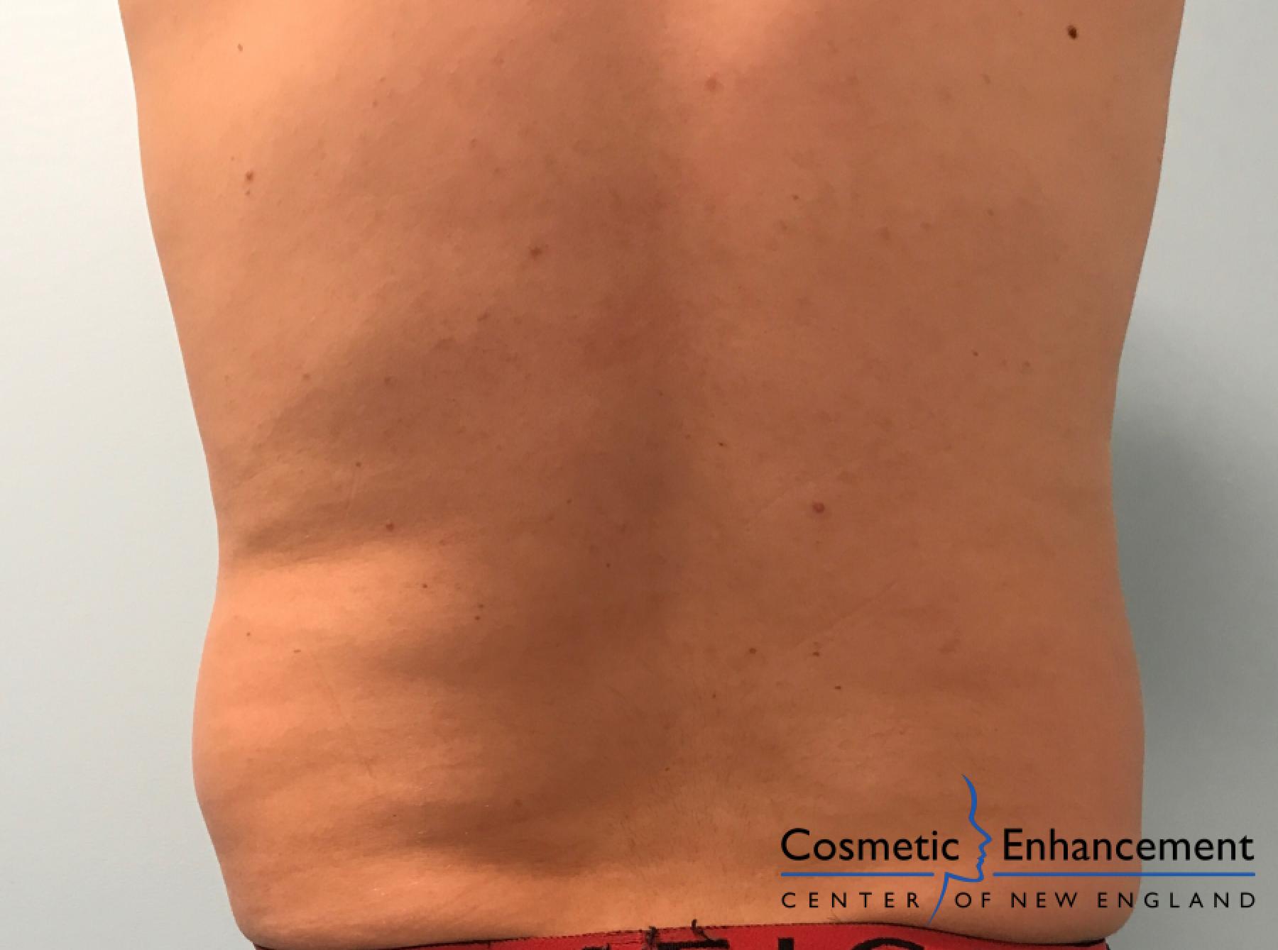 CoolSculpting®: Patient 7 - Before 