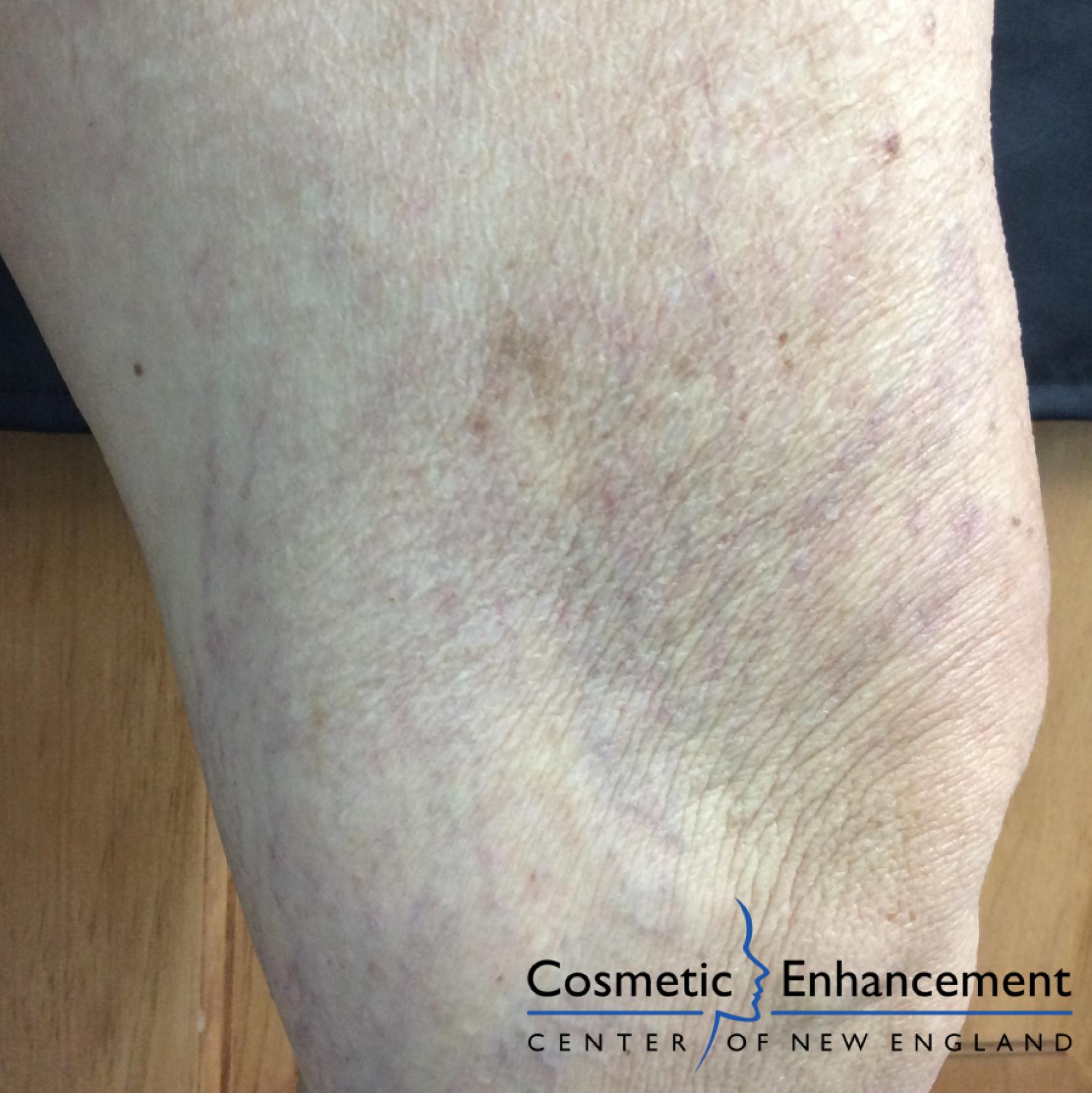 Sclerotherapy: Patient 2 - After 1