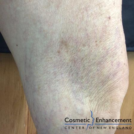 Sclerotherapy: Patient 2 - After Image 1
