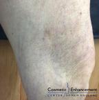 Sclerotherapy: Patient 2 - After 
