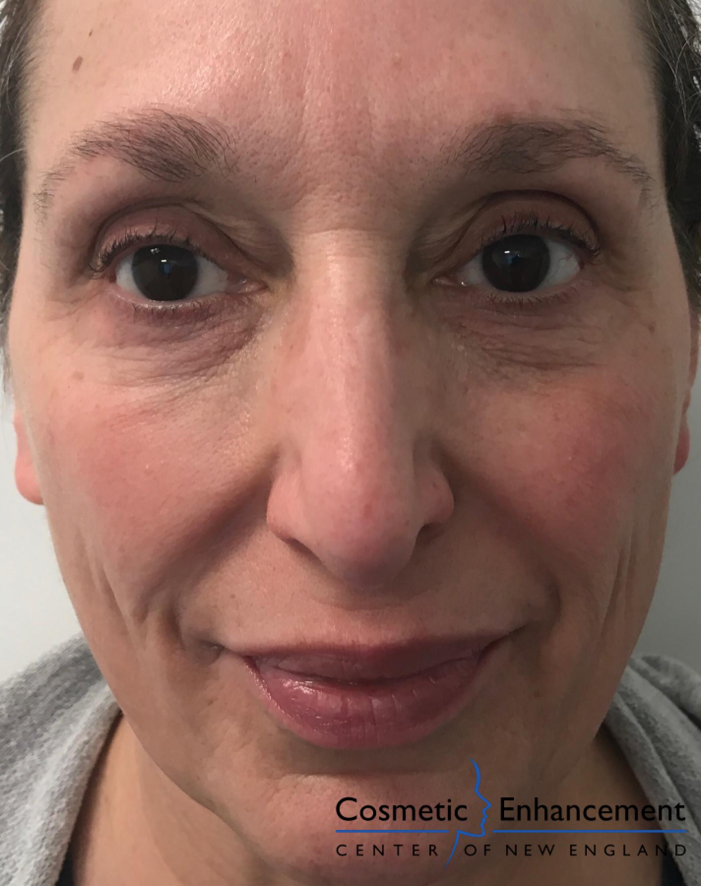 Fillers: Patient 3 - After 1