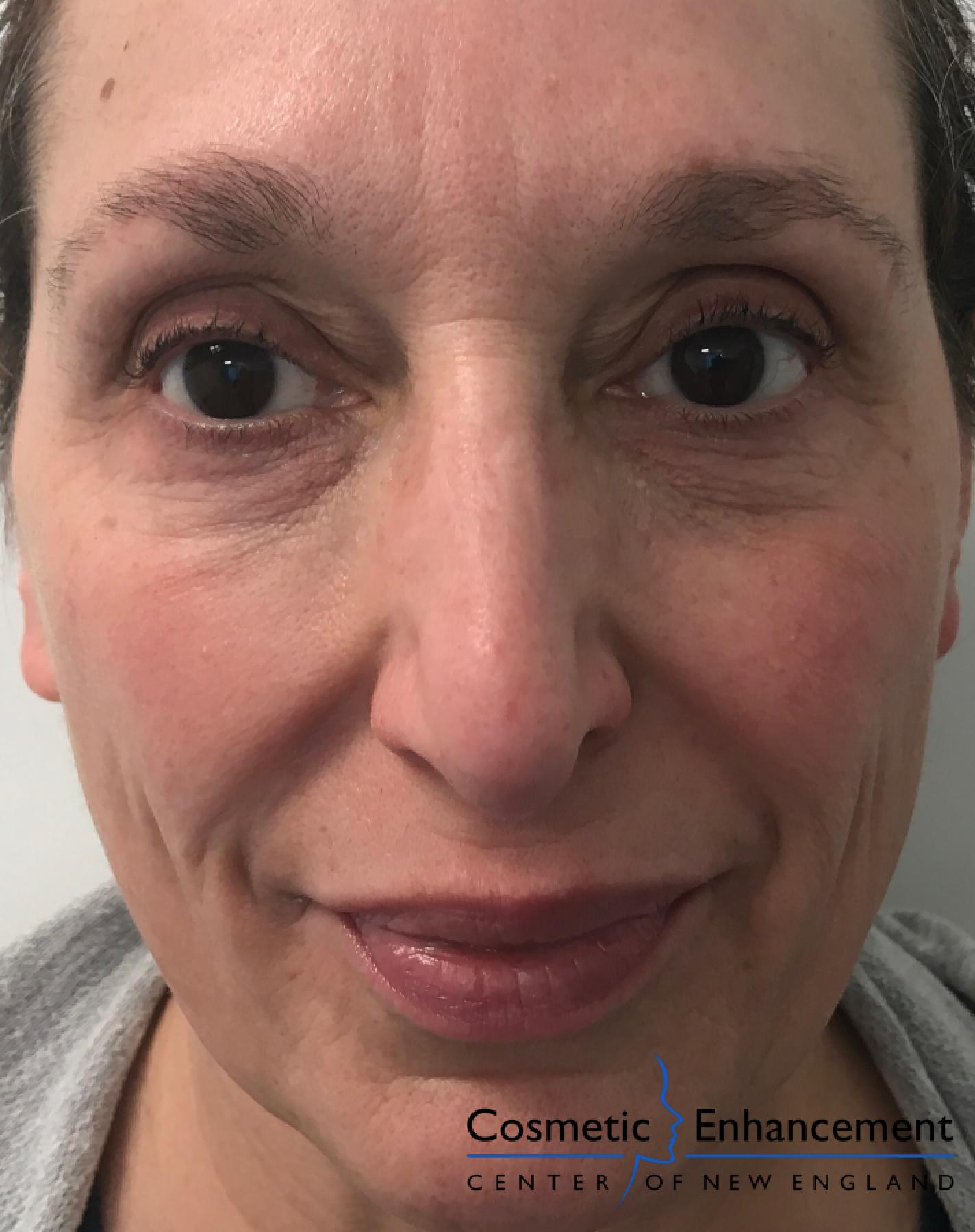 Fillers: Patient 3 - After  