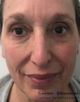 Fillers: Patient 3 - After 