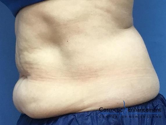 CoolSculpting®: Patient 16 - Before and After 2
