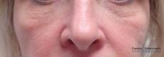 Sculptra: Patient 2 - Before 