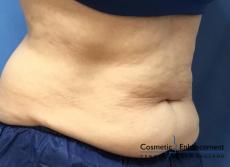 CoolSculpting®: Patient 16 - Before Image 