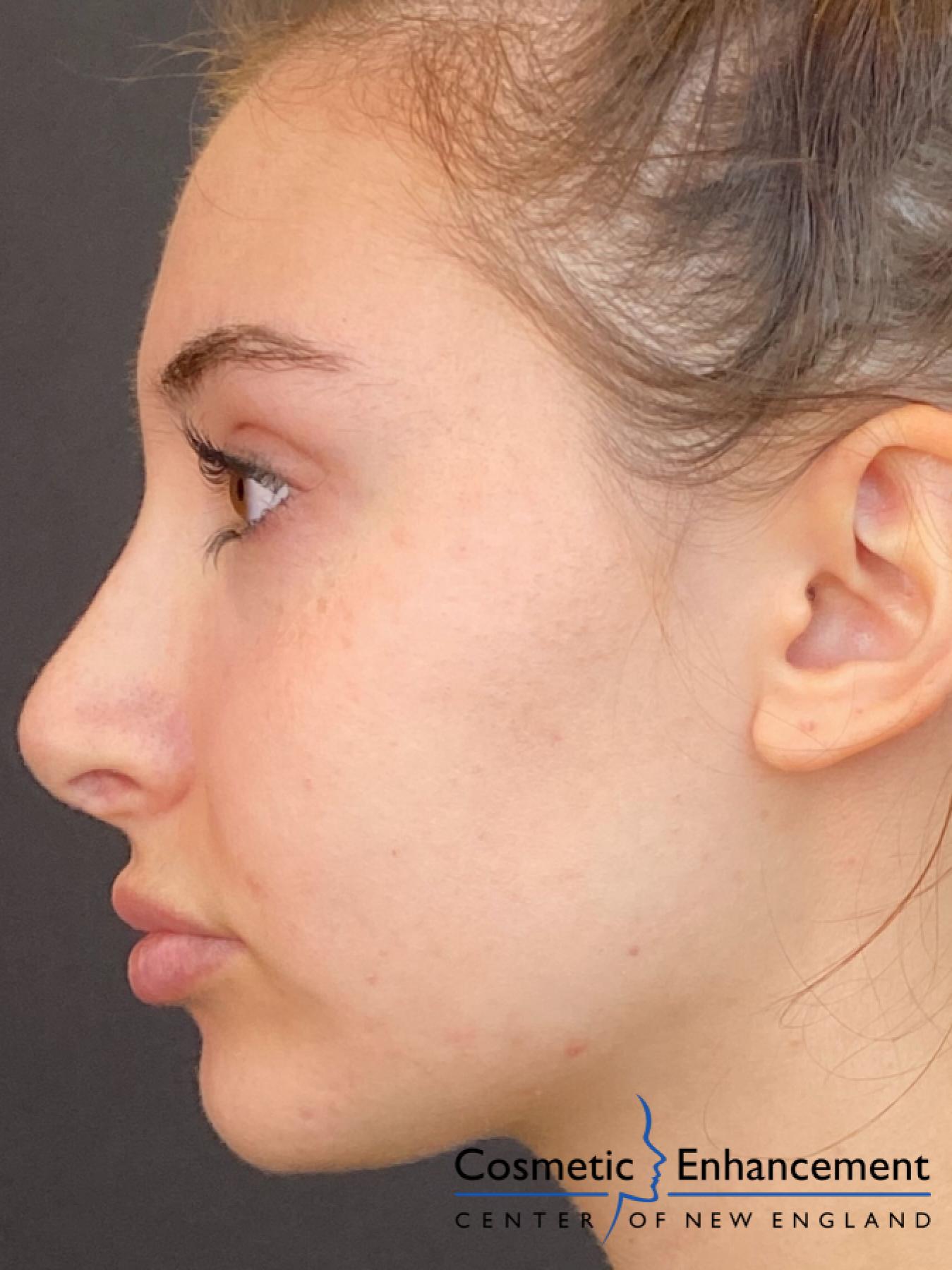 Fillers: Patient 6 - After  