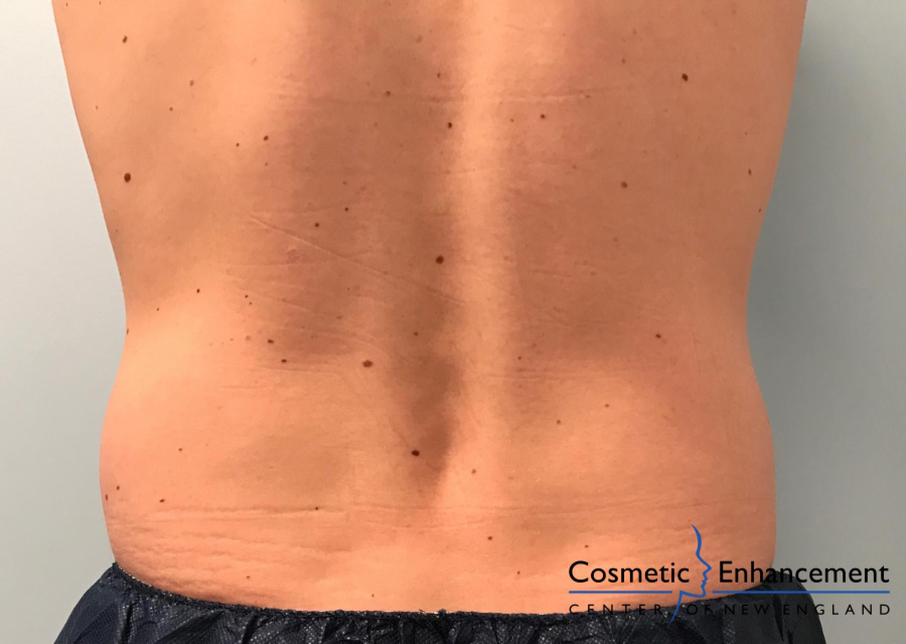 CoolSculpting®: Patient 13 - Before and After 2