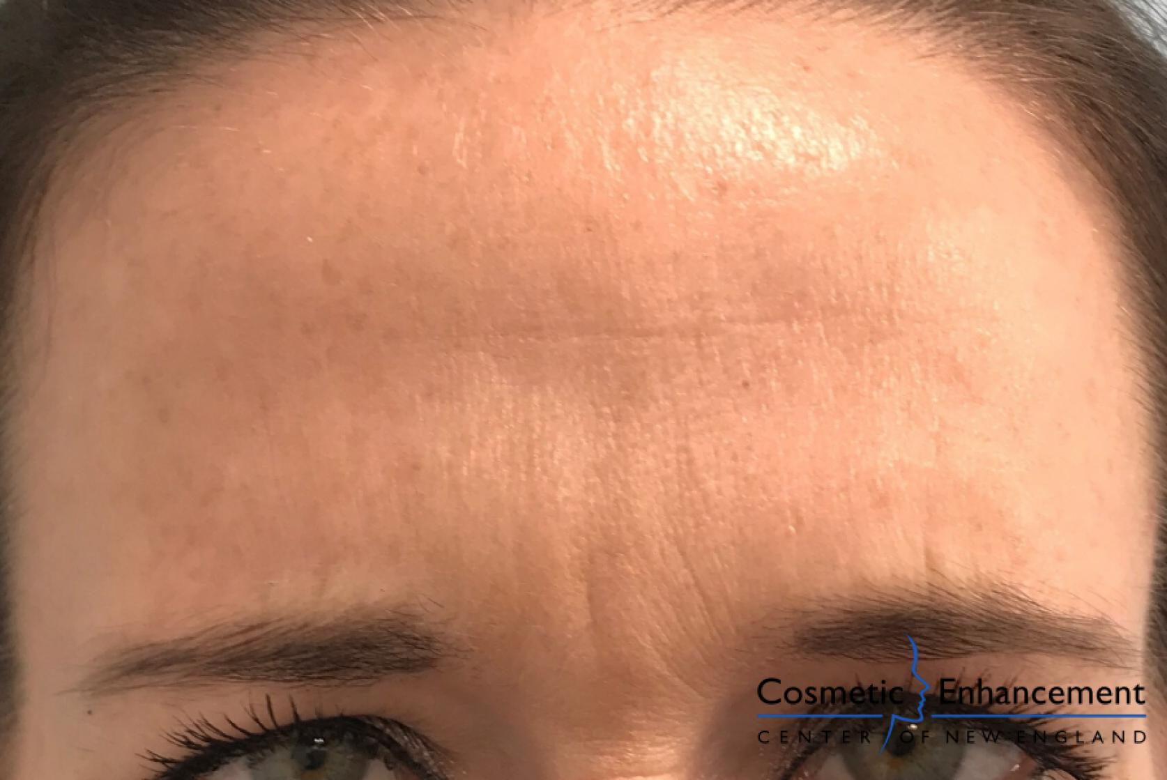 BOTOX® Cosmetic: Patient 6 - After  