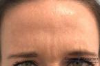 BOTOX® Cosmetic: Patient 6 - After 