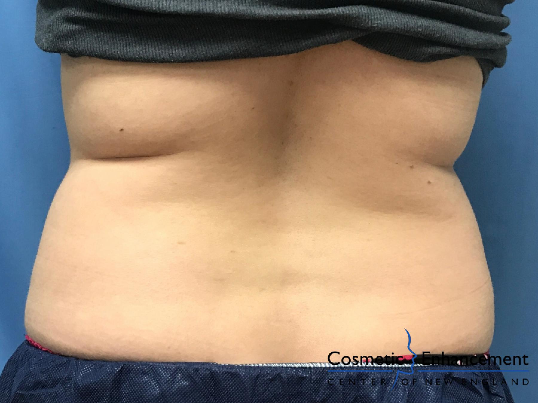 CoolSculpting®: Patient 21 - Before and After 2