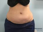 CoolSculpting®: Patient 15 - After Image 