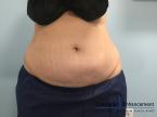 CoolSculpting®: Patient 15 - After 