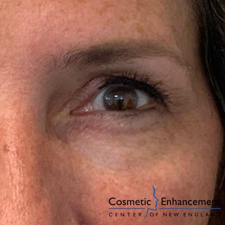 Ultherapy®: Patient 5 - After Image 2