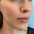 Fillers: Patient 2 - After 