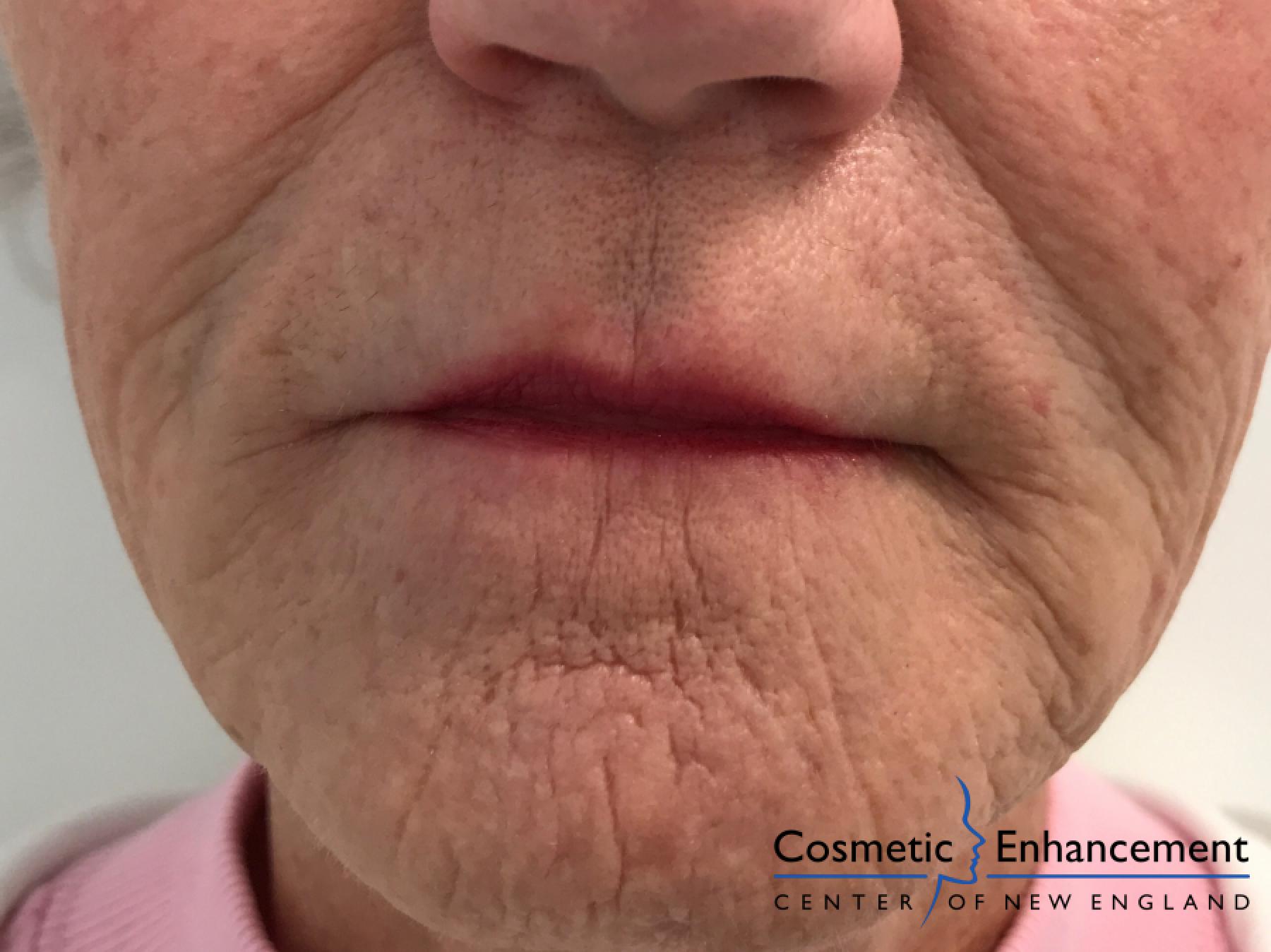 PiXel8 Microneedling RF: Patient 1 - Before and After 3