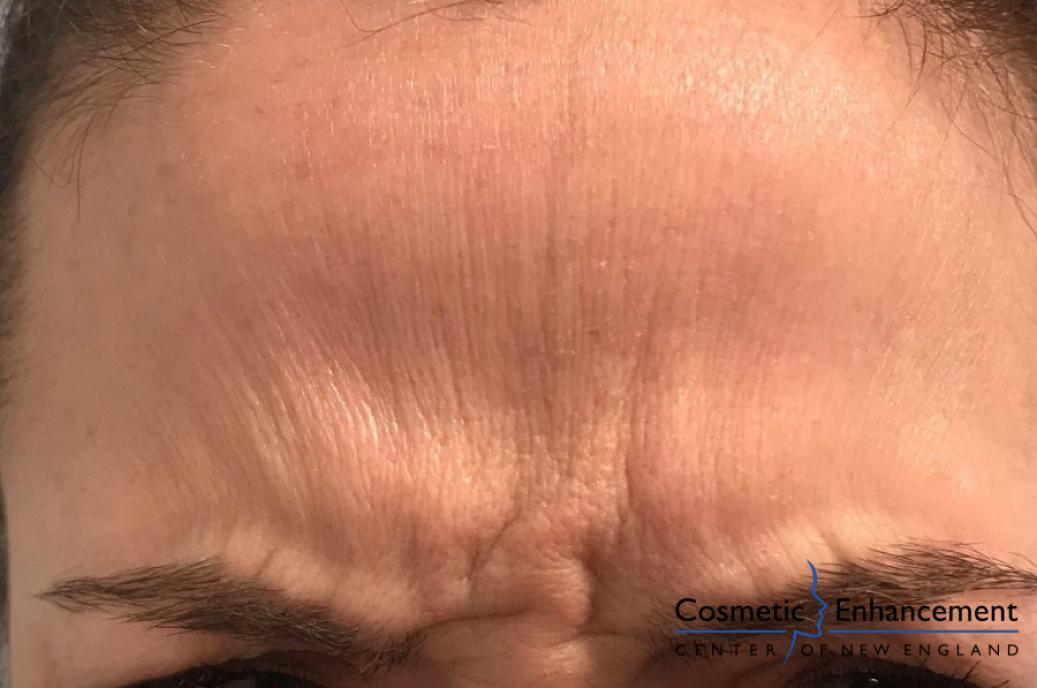 BOTOX® Cosmetic: Patient 5 - Before 