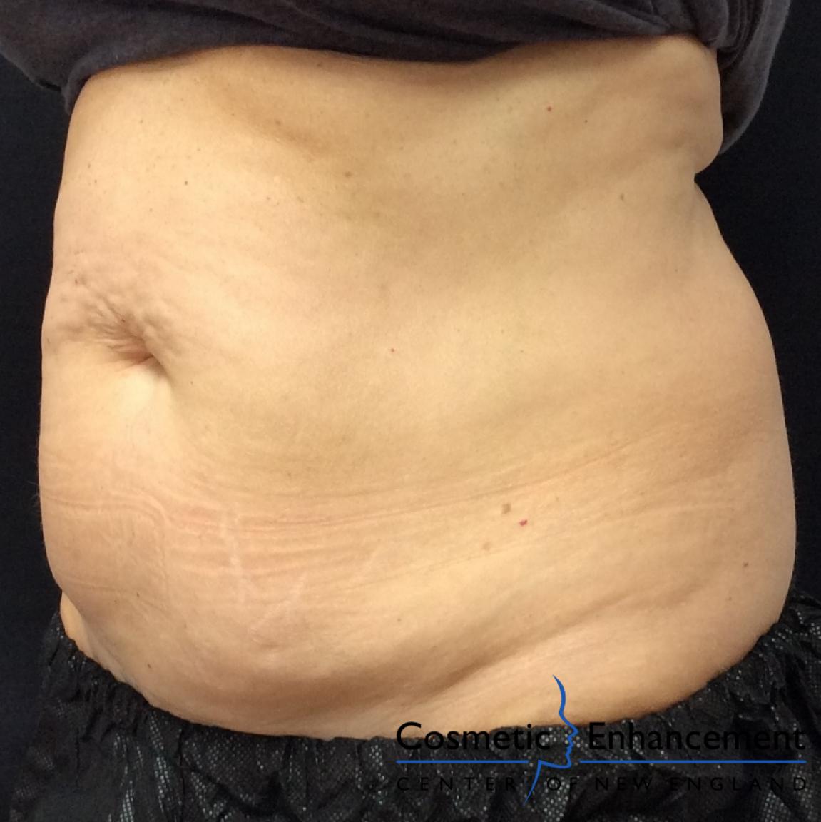 CoolSculpting®: Patient 8 - Before 1