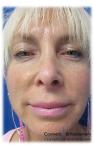 Vampire Facelift: Patient 1 - After Image 