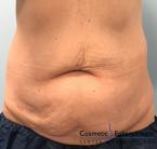 CoolSculpting®: Patient 14 - After 