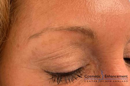 Microblading: Patient 6 - Before Image 1