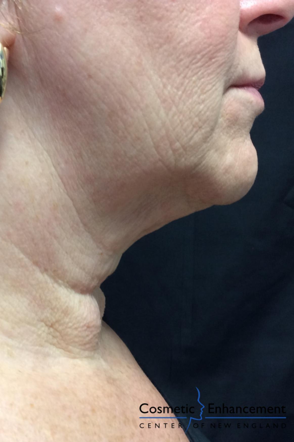 Ultherapy®: Patient 2 - After  