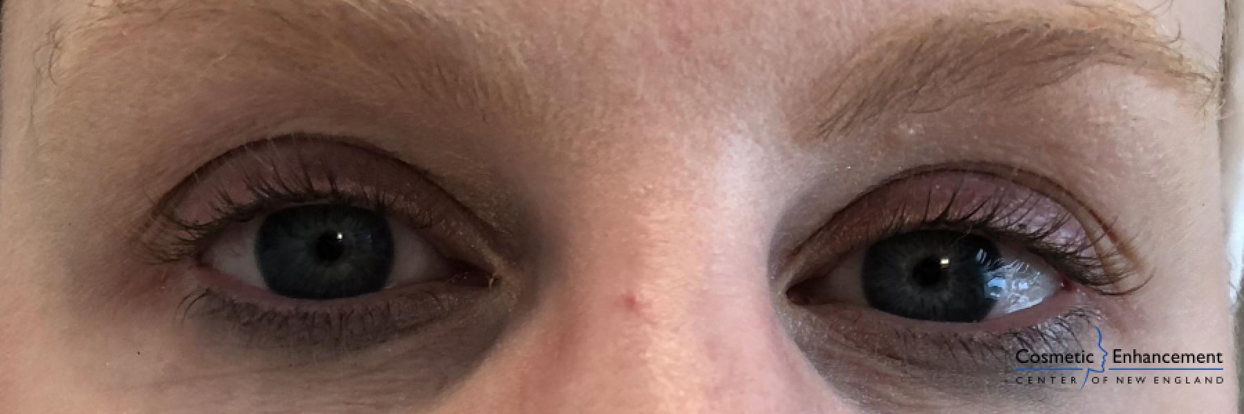 Lash Lift And Tint: Patient 2 - Before 1