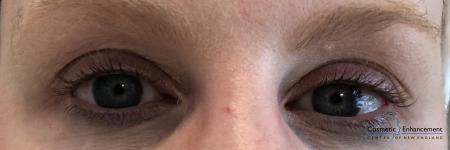 Lash Lift And Tint: Patient 3 - Before Image 1