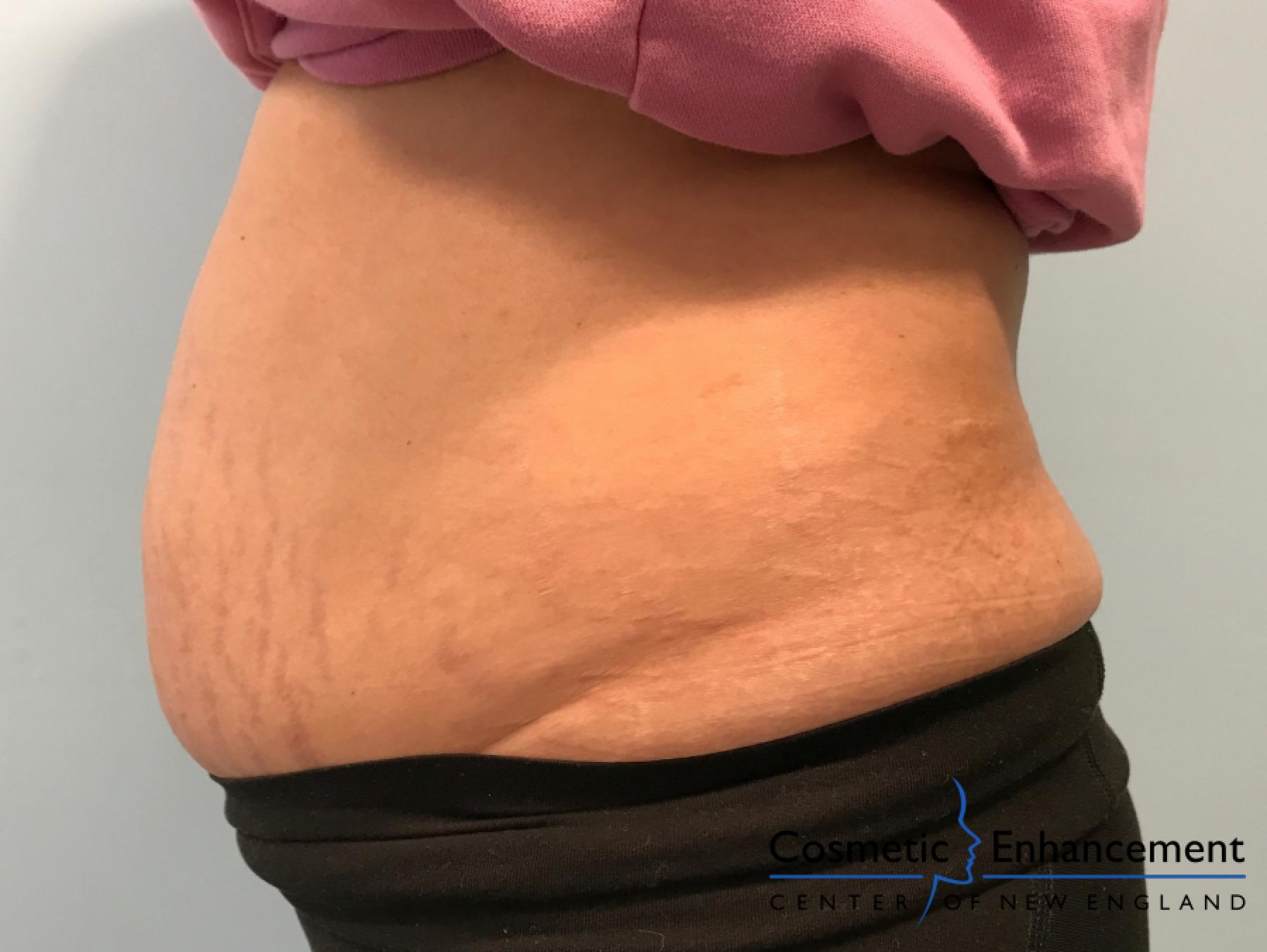 Emsculpt Neo: Patient 1 - Before and After 2