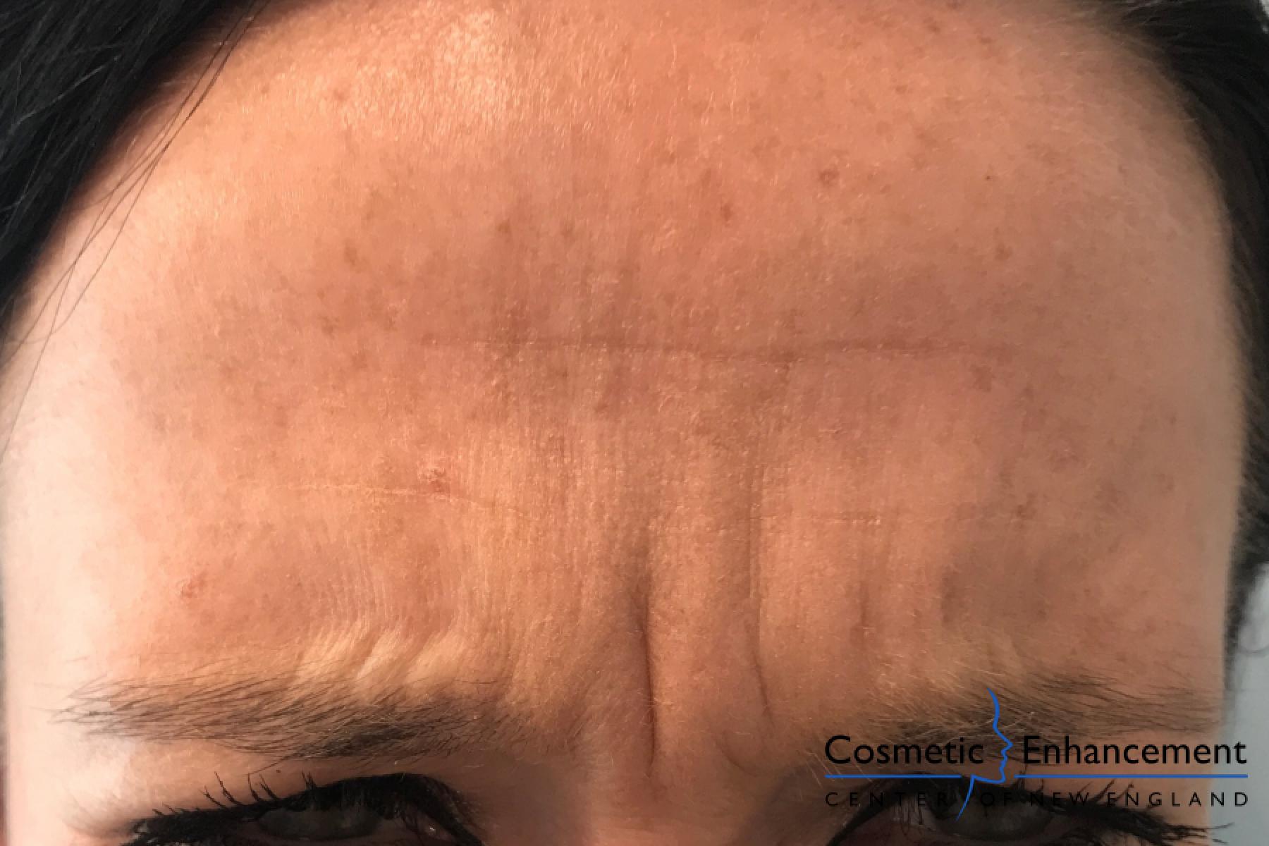 BOTOX® Cosmetic: Patient 6 - After  