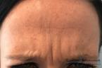 BOTOX® Cosmetic: Patient 6 - Before Image 