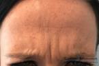 BOTOX® Cosmetic: Patient 6 - Before 
