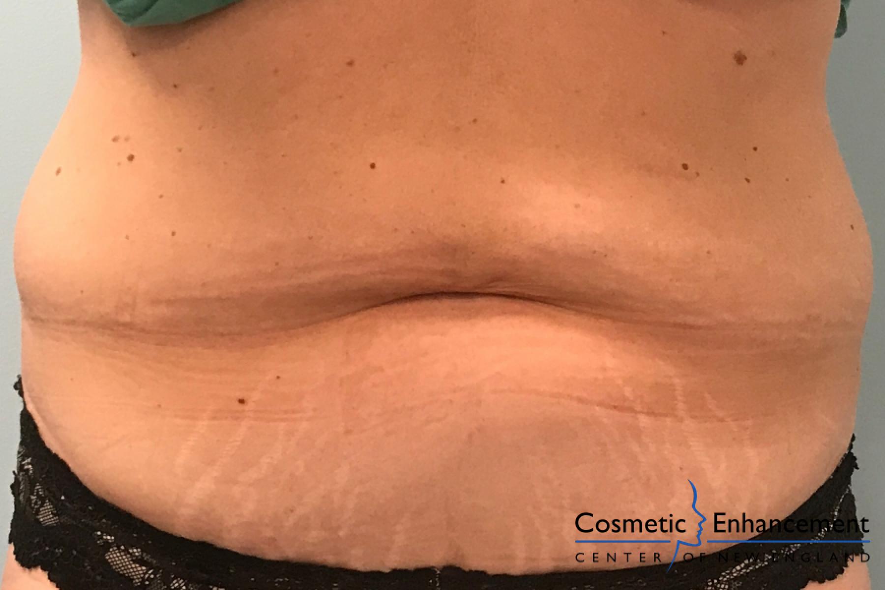 CoolSculpting®: Patient 10 - Before 1