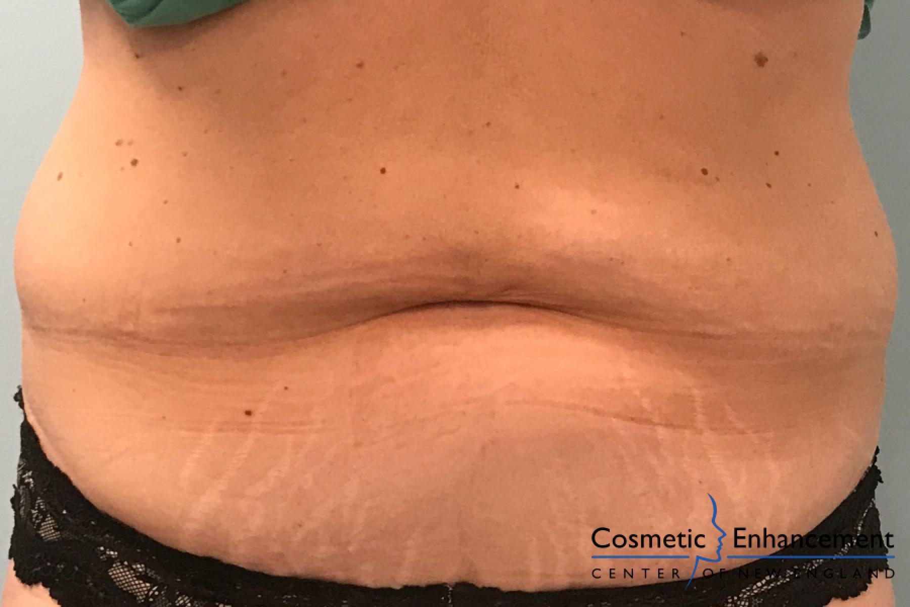 CoolSculpting®: Patient 10 - After  