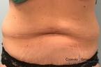 CoolSculpting®: Patient 10 - Before 