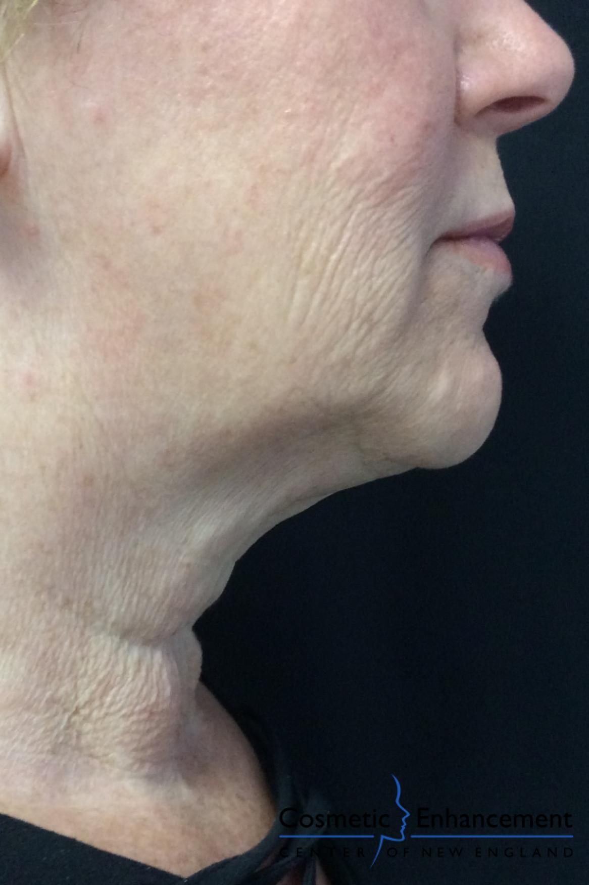 Ultherapy®: Patient 2 - After  