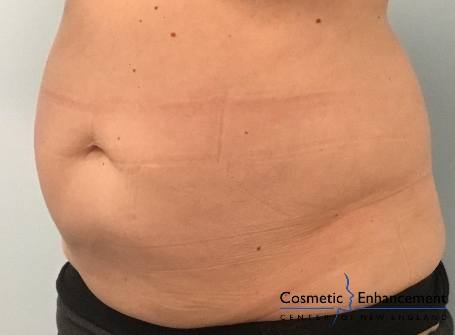 CoolSculpting®: Patient 3 - After  