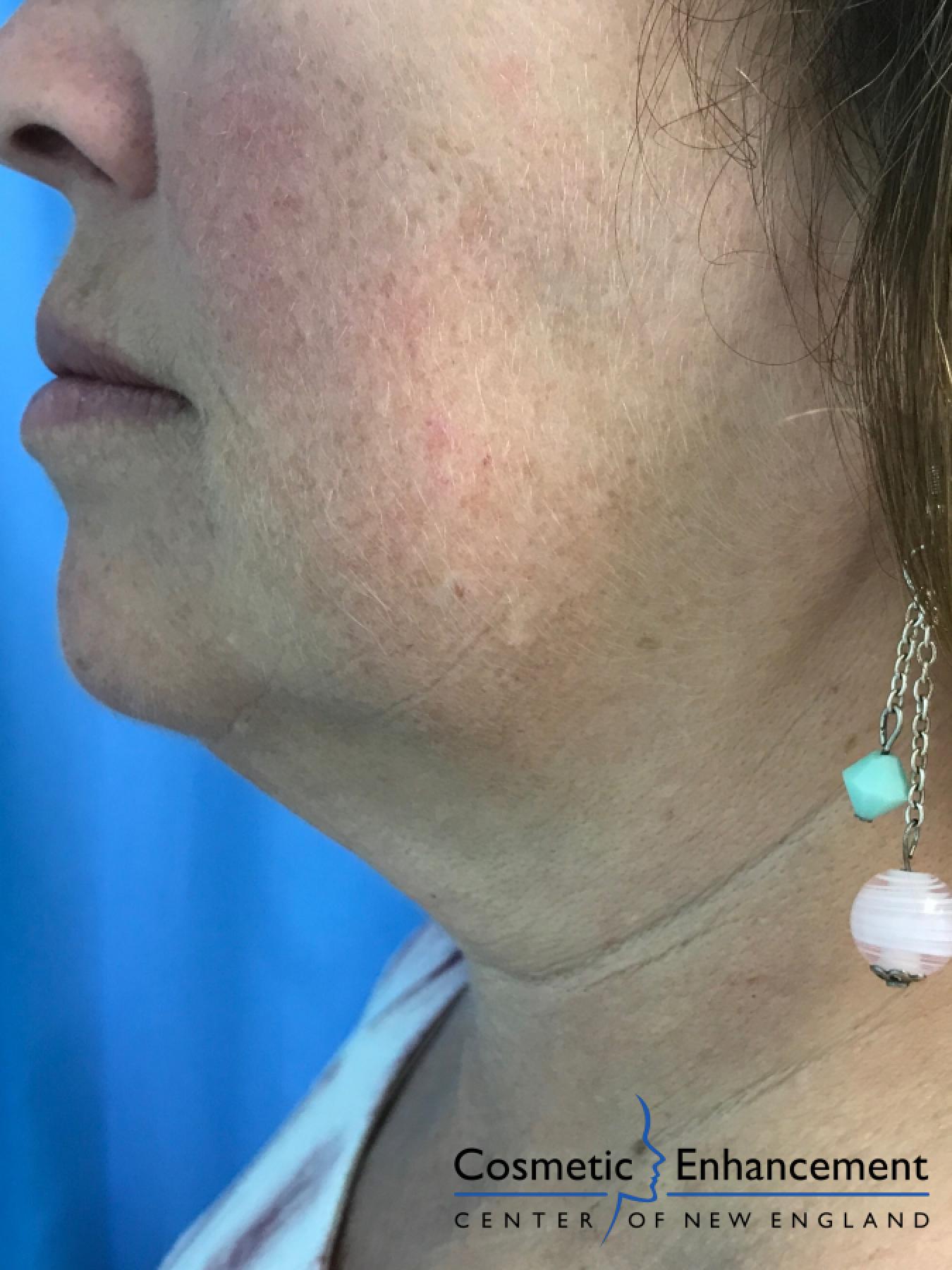 Ultherapy®: Patient 1 - After 1