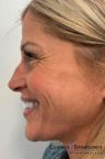 BOTOX® Cosmetic: Patient 1 - Before 