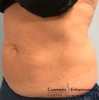 CoolSculpting®: Patient 8 - After 