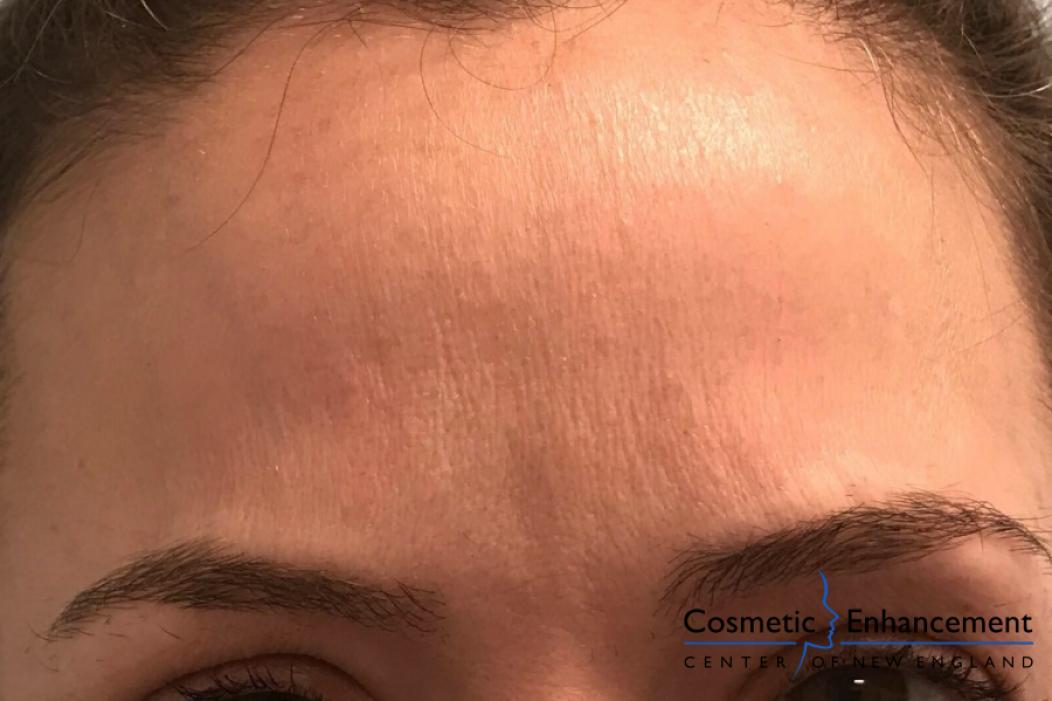 BOTOX® Cosmetic: Patient 5 - After  
