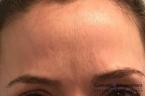 BOTOX® Cosmetic: Patient 5 - After 
