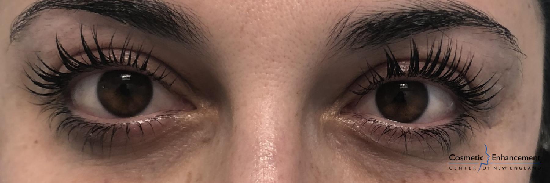 Lash Lift And Tint: Patient 1 - After  