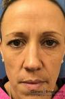 BOTOX® Cosmetic: Patient 7 - After 