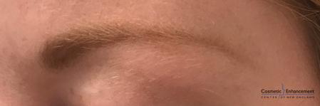 Microblading: Patient 4 - Before and After Image 3